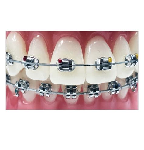 metal orthodontic bracket manufacturer|pictures of traditional steel braces.